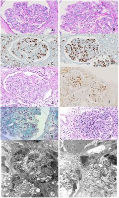 Renal involvement as a unique manifestation of hemophagocytic syndrome